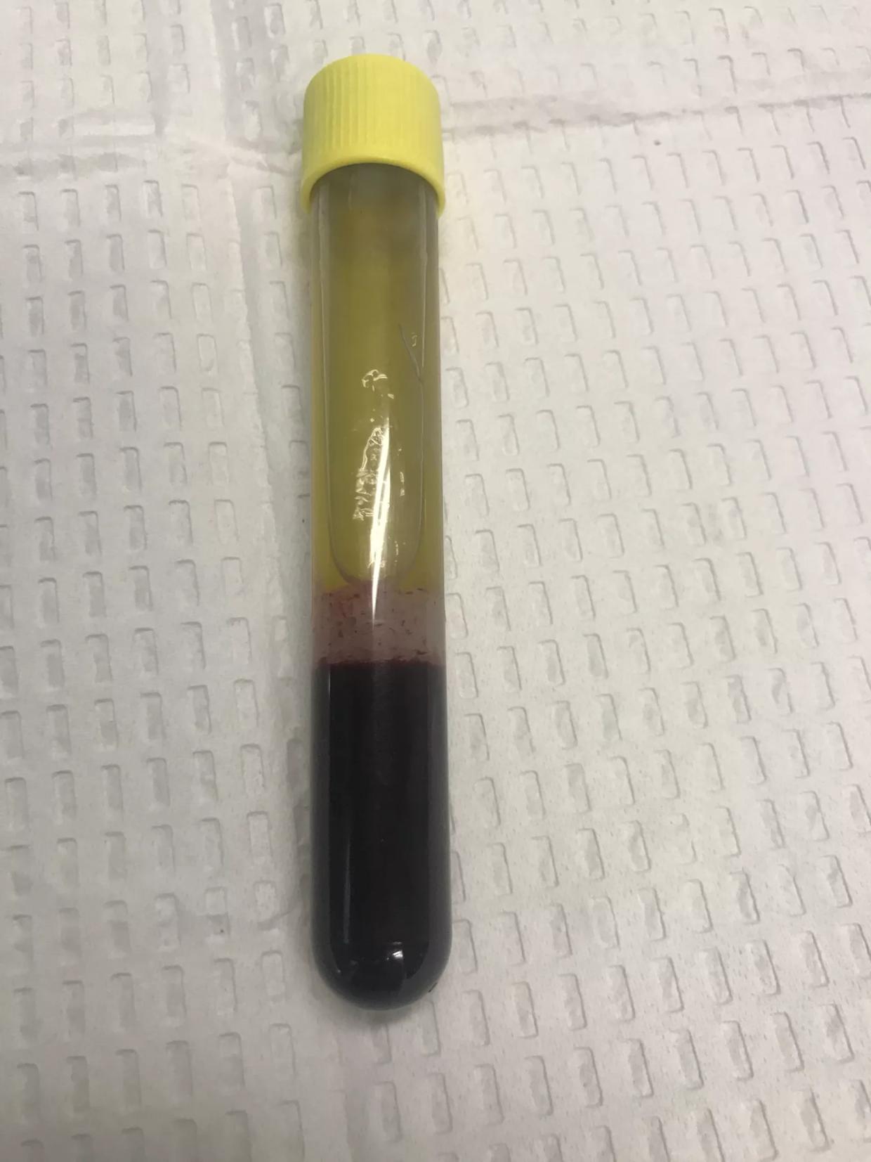 I Got a Face-Numbing Vampire Facial Using My Own Blood and Lived to Tell