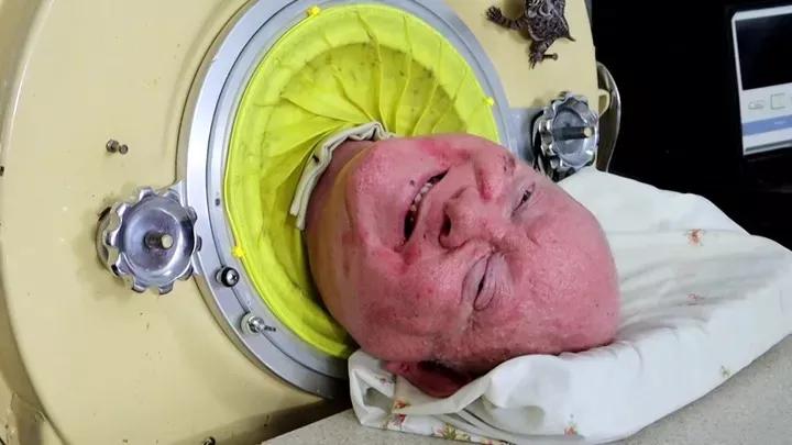 Lawyer and Dallas native Paul Alexander in an iron lung.